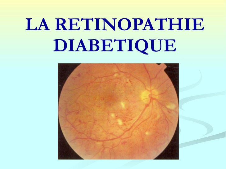 Cours De R Tinopathie Diab Tique Pdf Etude Az