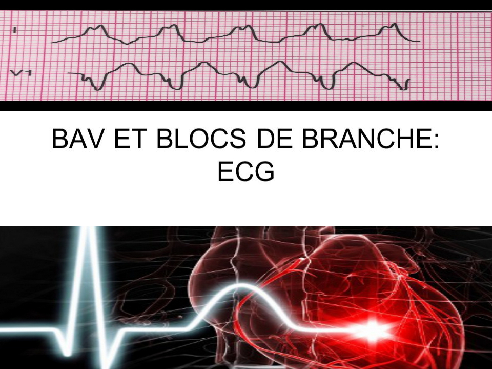 BAV ET BLOCS DE BRANCHE: ECG .PDF