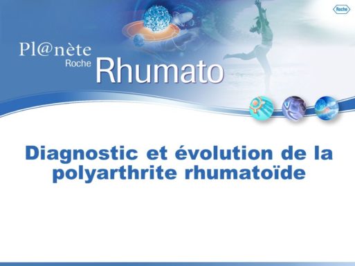 Diagnostic et évolution de la polyarthrite rhumatoïde .PDF - ETUDE-AZ