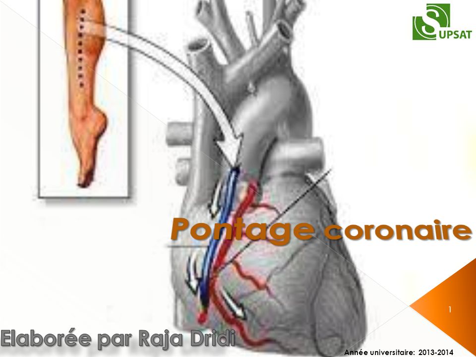 Pontage coronaire .PDF