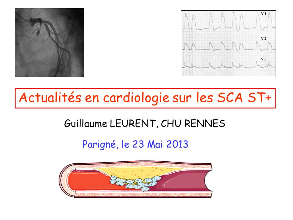 Actualités en cardiologie sur les SCA ST+ .PDF