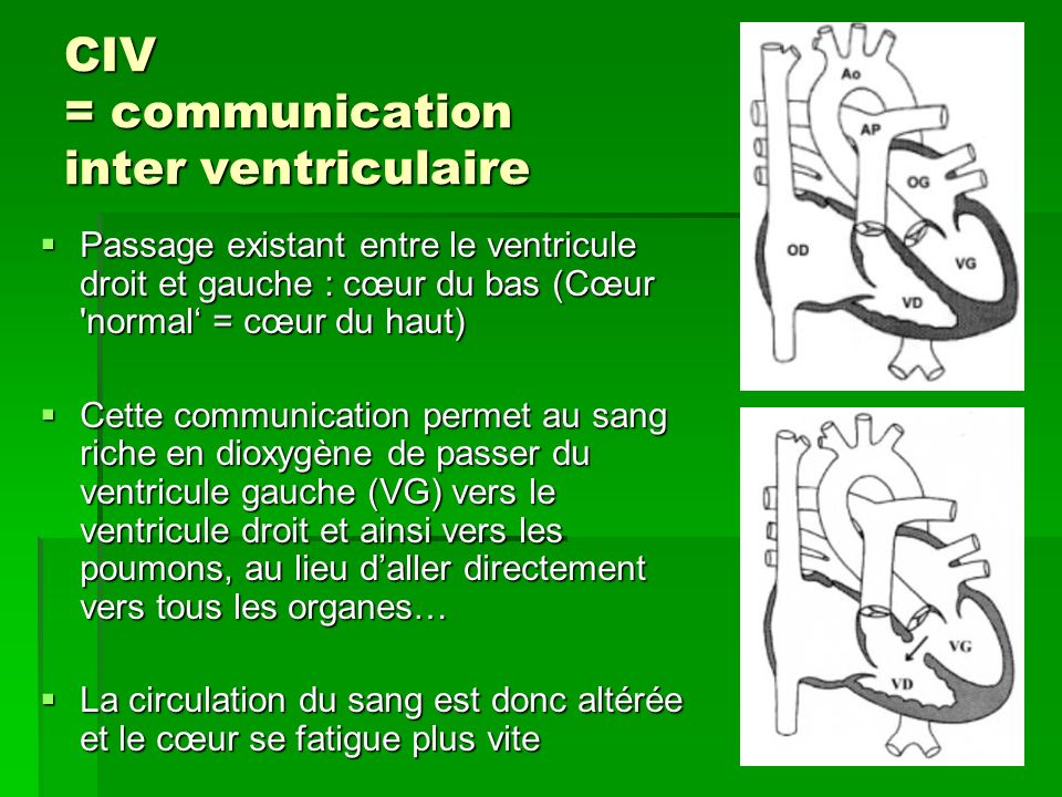 CIV = communication inter ventriculaire .PDF