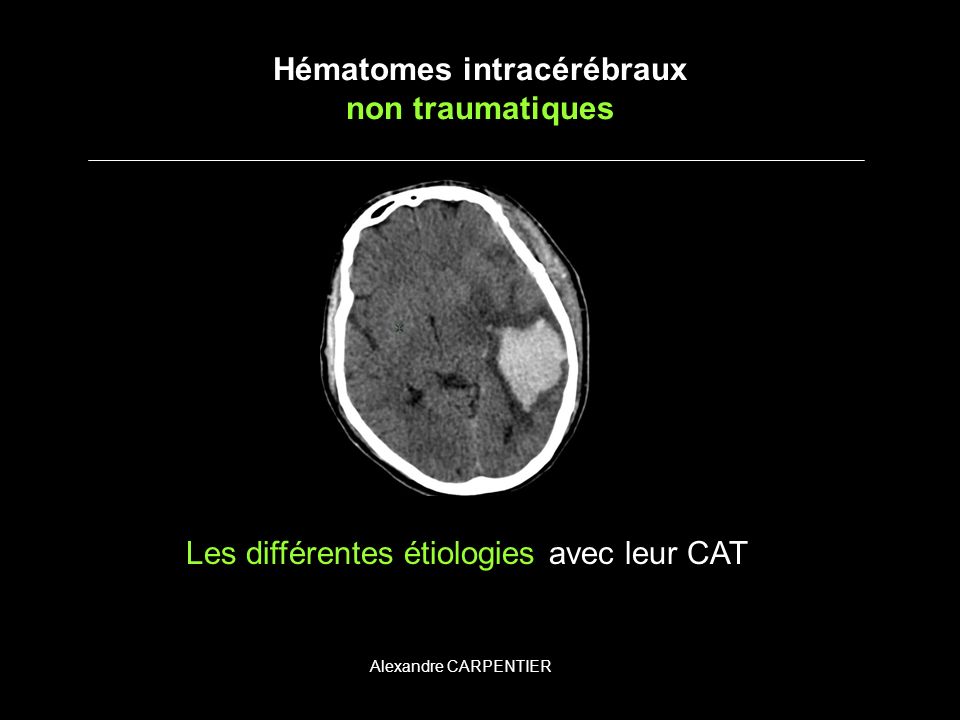 Hématomes intracérébraux non traumatiques .PDF
