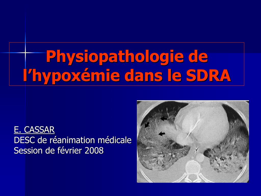Physiopathologie de l’hypoxémie dans le SDRA .PDF