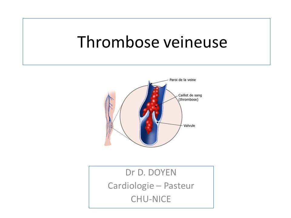 Thrombose veineuse .PDF