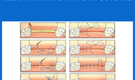 Les différents types de sutures .PDF
