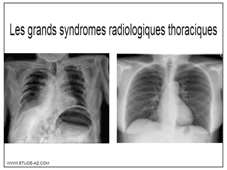 les-grands-syndromes-radiologiques-thoraciques-pdf-etude-az