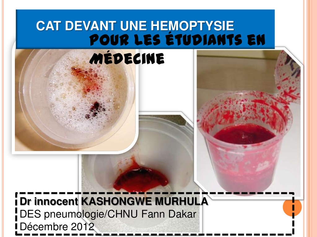 CAT devant une hémoptysie .PDF