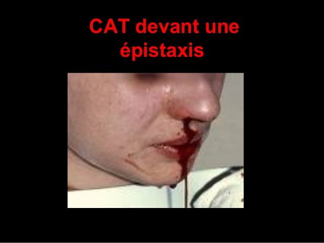 CAT devant une épistaxis .PDF