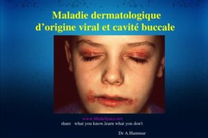 Maladie dermatologique d’origine viral et cavité buccale .PDF