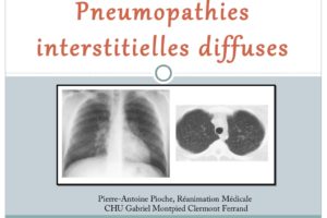 Pneumopathies Interstitielles Diffuses .PDF