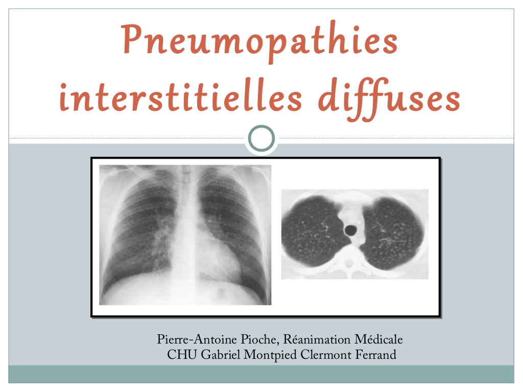 Pneumopathies Interstitielles Diffuses .PDF