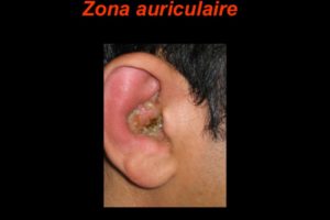Zona auriculaire .PDF