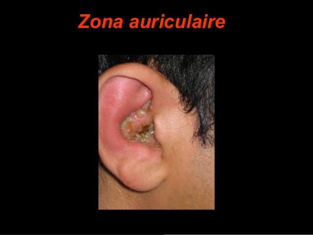 Zona Auriculaire PDF ETUDE AZ Zona Auriculaire PDF ETUDE AZ