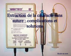 Extraction de la cataracte sans suture complications et solutions