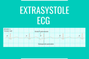 Extrasystole ECG