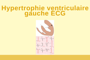 Hypertrophie ventriculaire gauche ECG