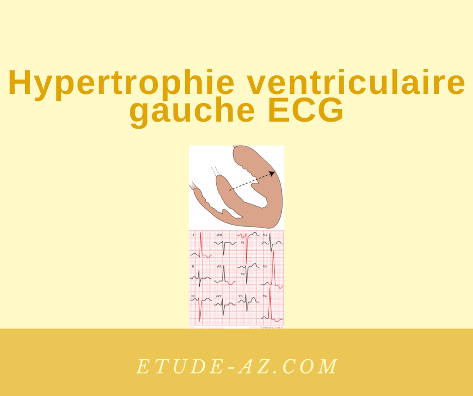 Hypertrophie ventriculaire gauche ECG